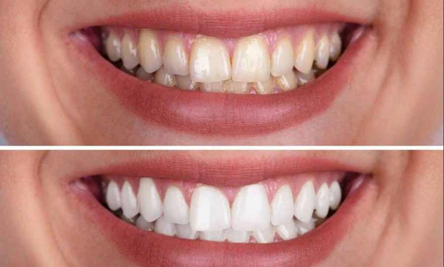 Discoloration Teeth 