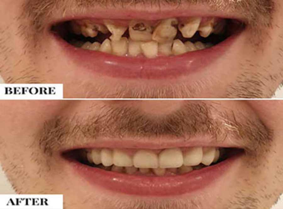 Malaligned Teeth