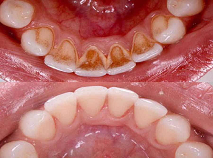 Bad Breath Halitosis