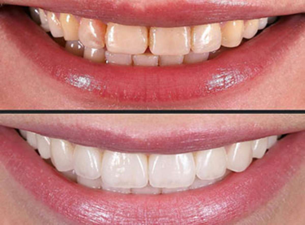 Dental Veneers