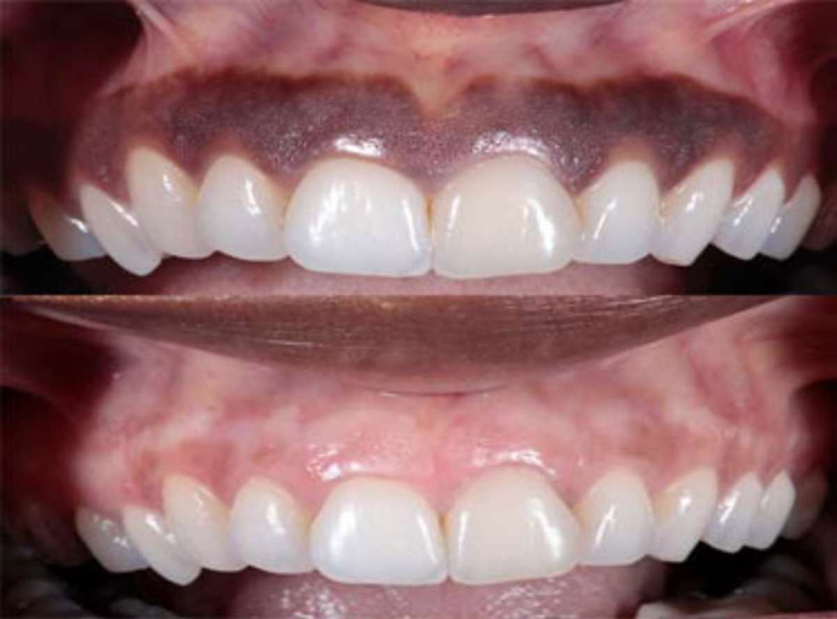 Gum Depigmentation